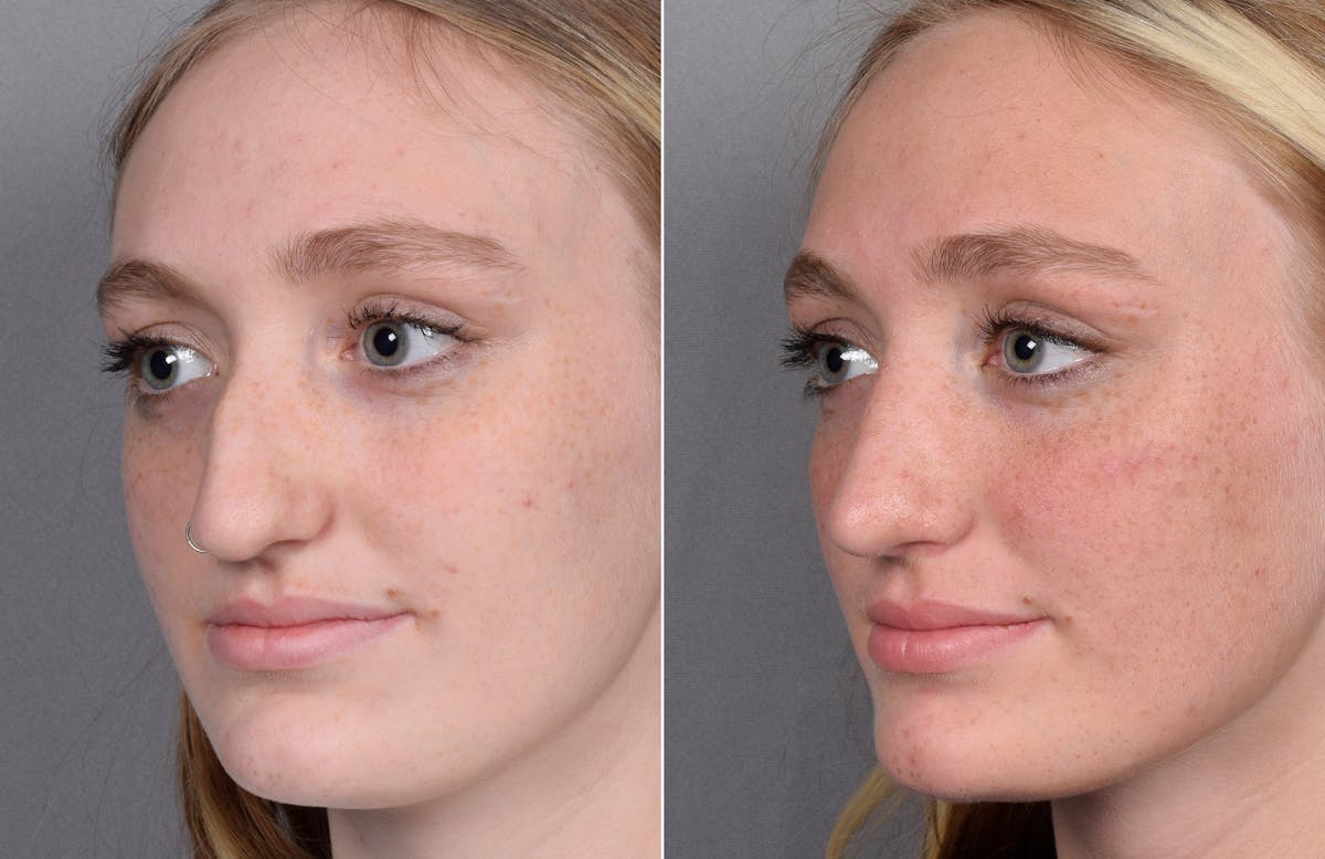 Rhinoplasty Before & After Gallery - Patient 377175 - Image 4