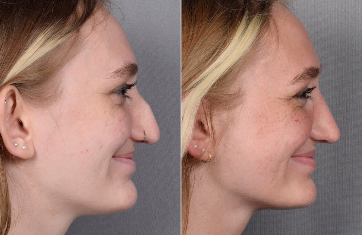 Rhinoplasty Before & After Gallery - Patient 377175 - Image 5