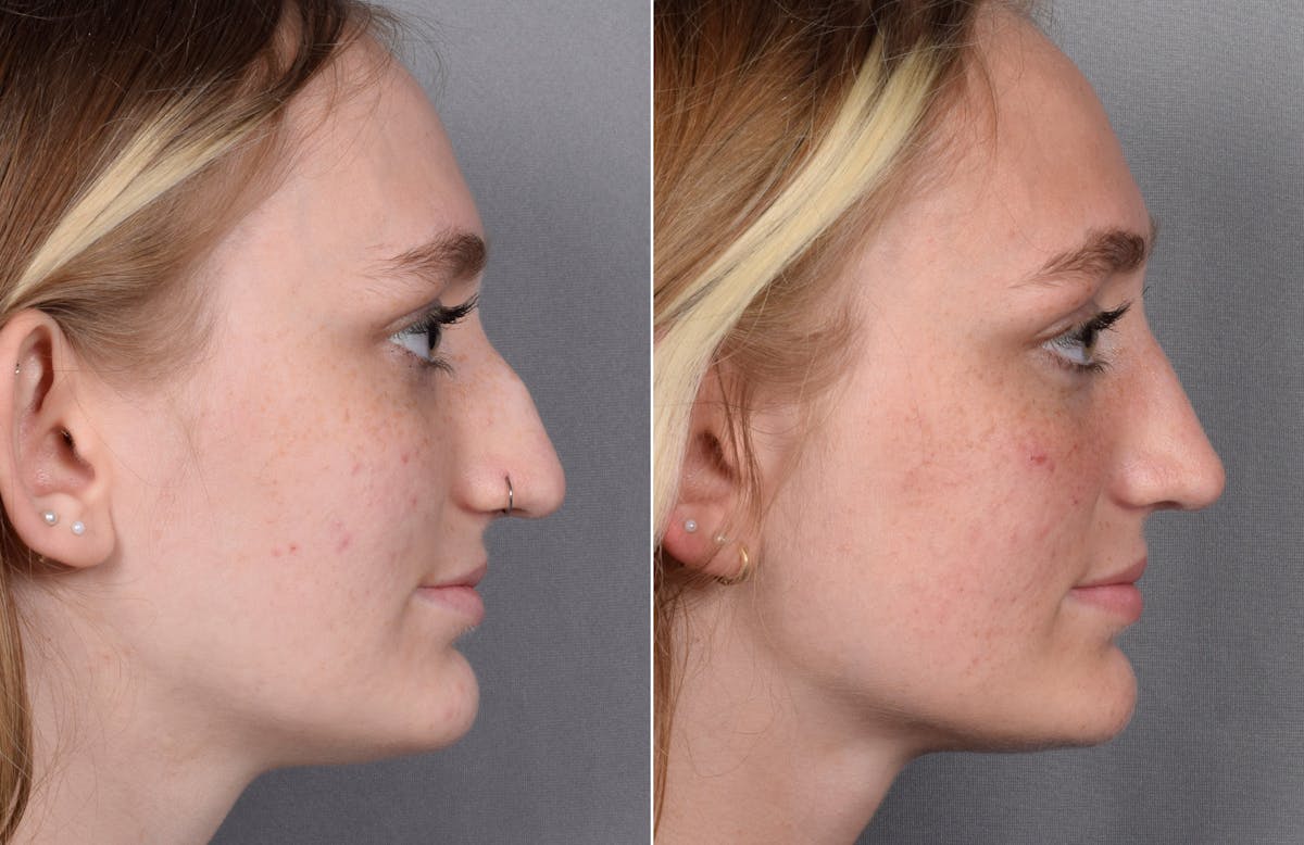 Rhinoplasty Before & After Gallery - Patient 377175 - Image 2