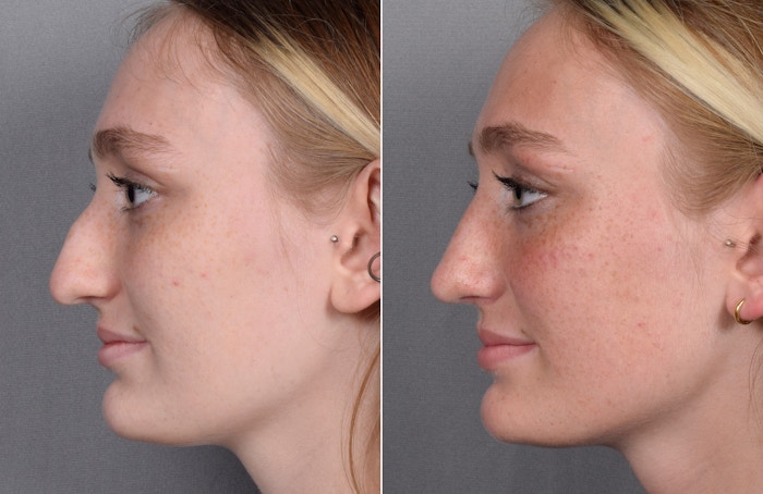 Rhinoplasty Before & After Gallery - Patient 377175 - Image 1
