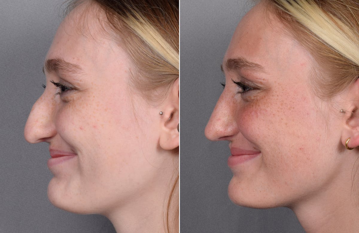 Rhinoplasty Before & After Gallery - Patient 377175 - Image 6