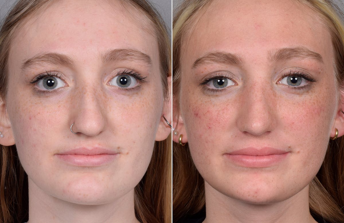 Rhinoplasty Before & After Gallery - Patient 377175 - Image 7