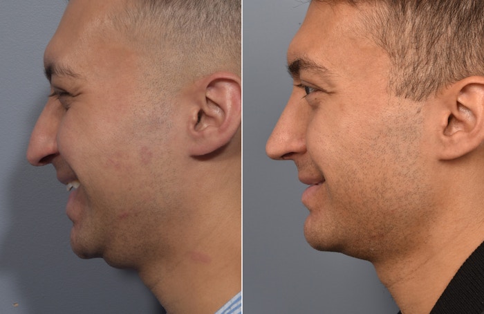 Rhinoplasty Before & After Gallery - Patient 638344 - Image 1