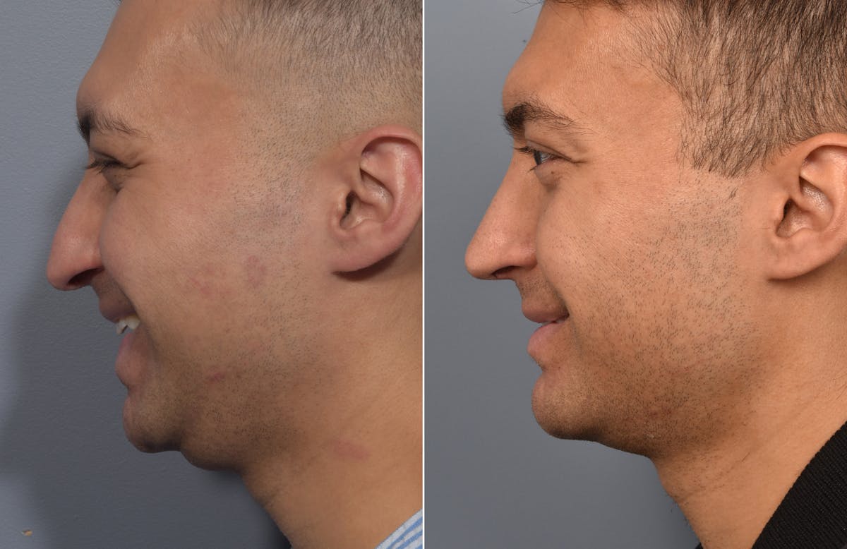Rhinoplasty Before & After Gallery - Patient 638344 - Image 1