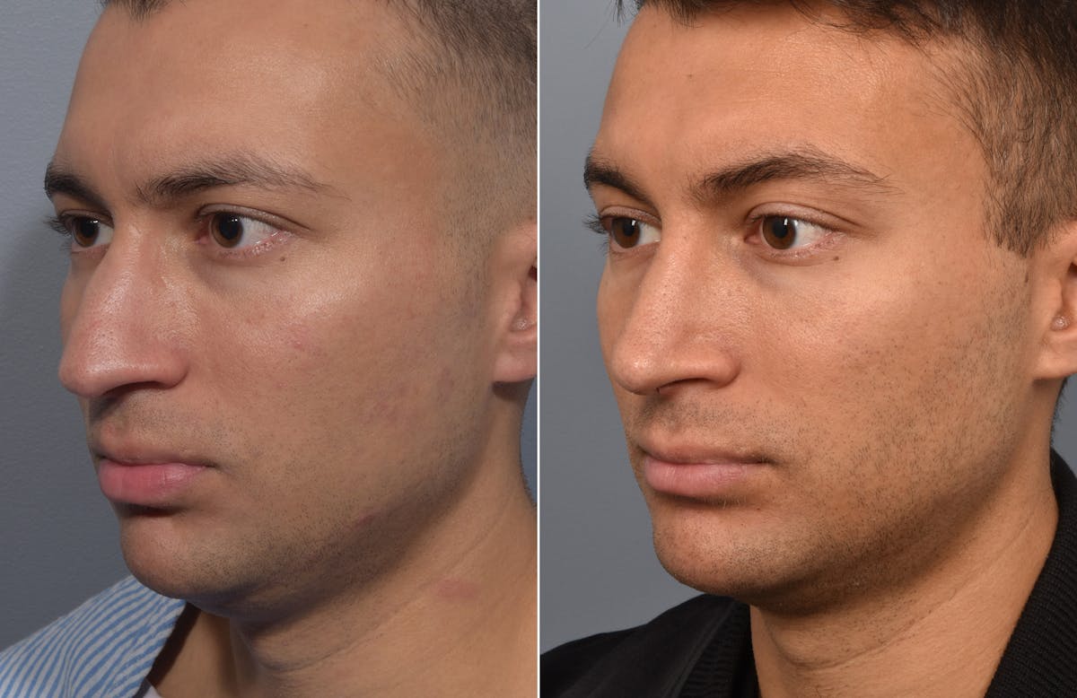 Rhinoplasty Before & After Gallery - Patient 638344 - Image 4