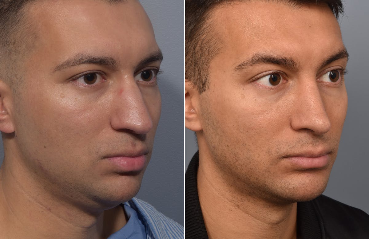Rhinoplasty Before & After Gallery - Patient 638344 - Image 5