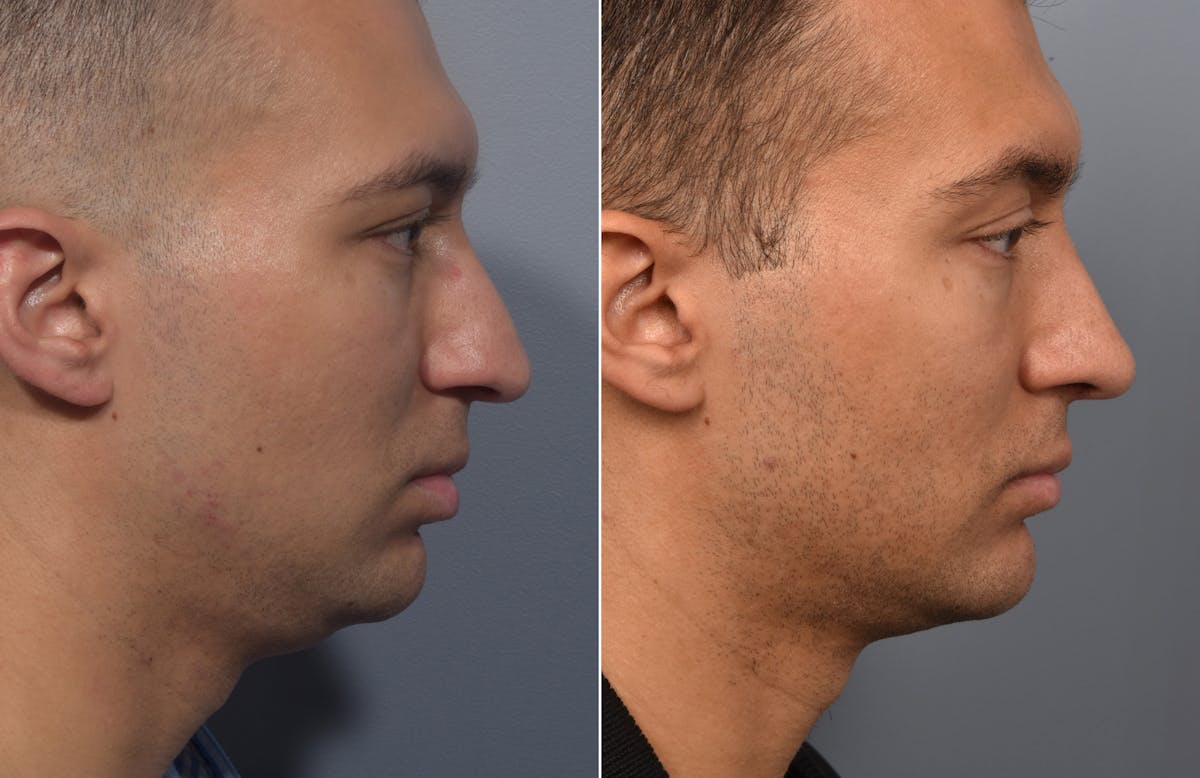 Rhinoplasty Before & After Gallery - Patient 638344 - Image 3