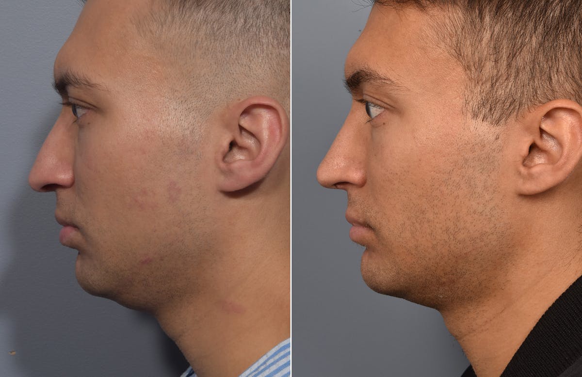 Rhinoplasty Before & After Gallery - Patient 341429 - Image 7