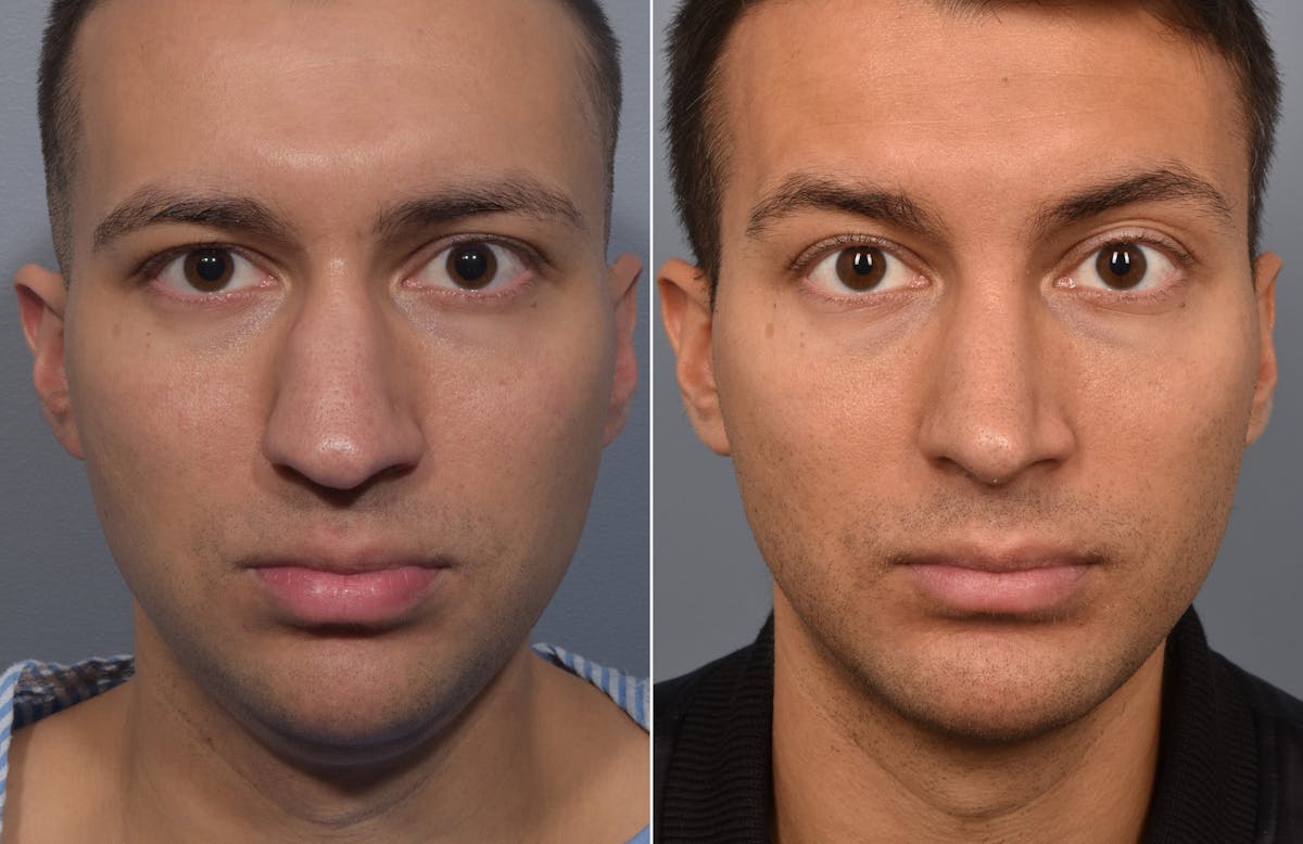 Rhinoplasty Before & After Gallery - Patient 638344 - Image 6