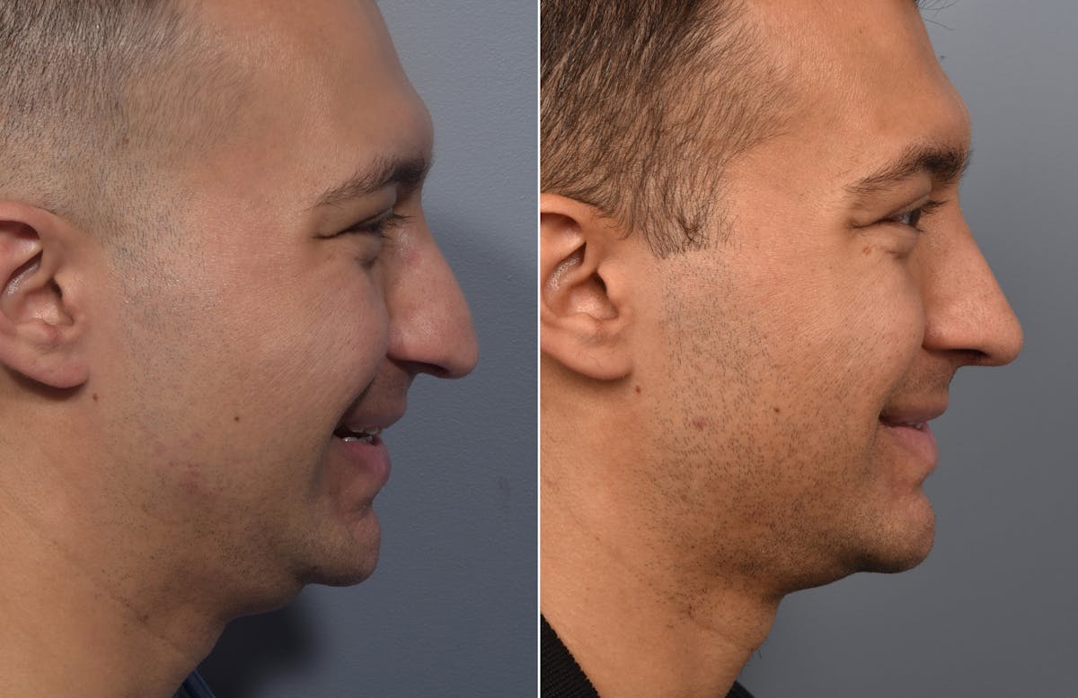 Rhinoplasty Before & After Gallery - Patient 638344 - Image 2