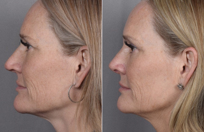 Rhinoplasty Before & After Gallery - Patient 149951 - Image 1