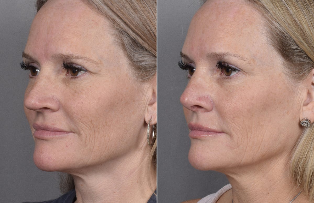 Rhinoplasty Before & After Gallery - Patient 149951 - Image 5
