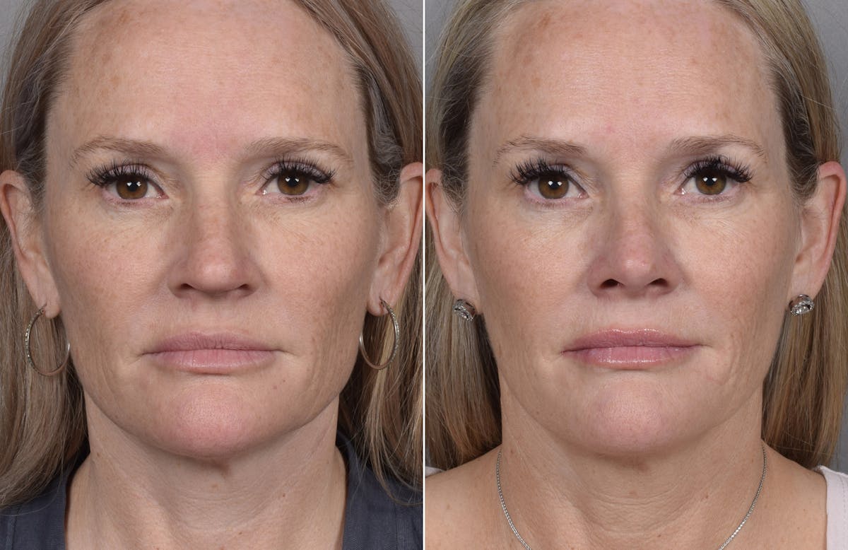 Rhinoplasty Before & After Gallery - Patient 149951 - Image 7