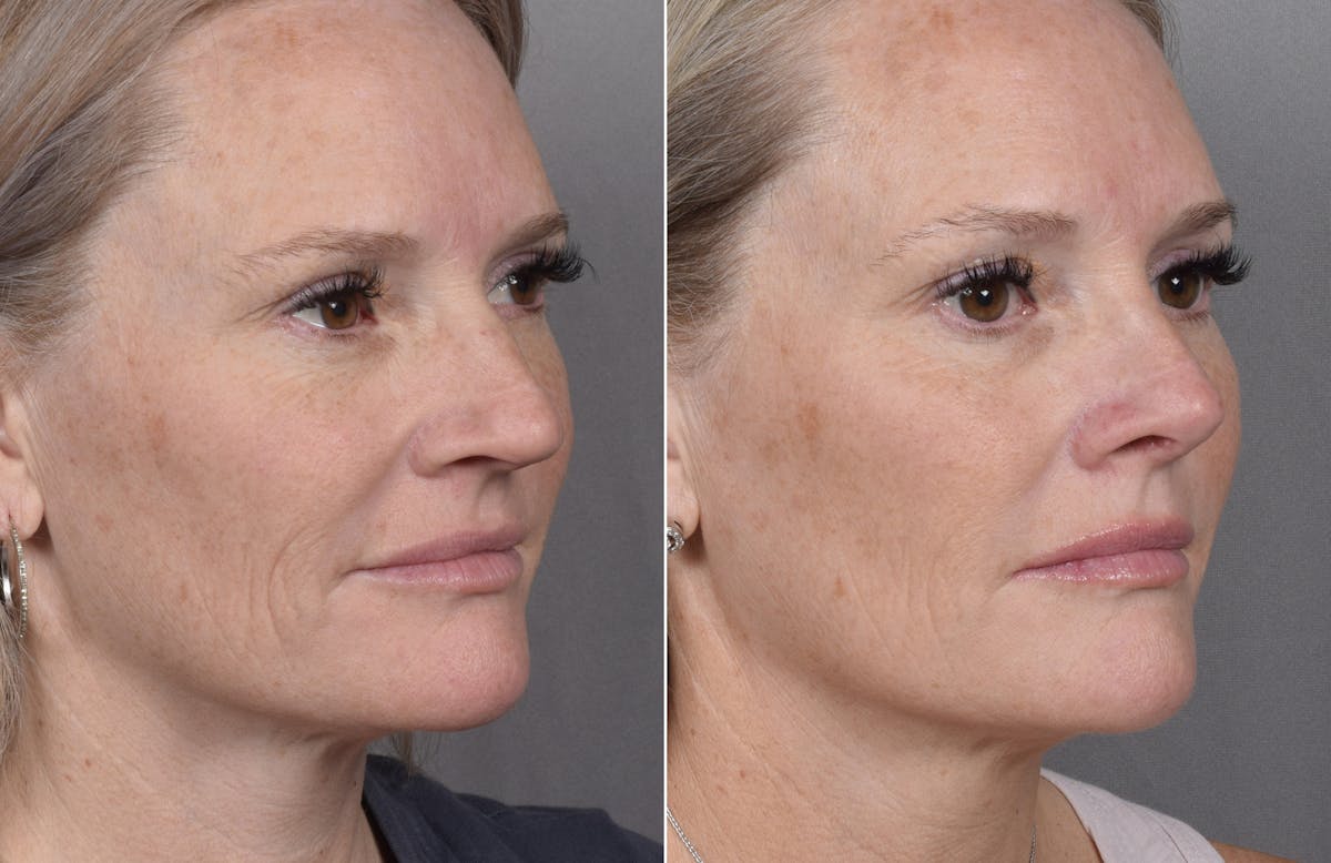 Rhinoplasty Before & After Gallery - Patient 149951 - Image 6