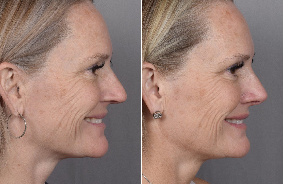 Rhinoplasty Before & After Gallery - Patient 149951 - Image 4