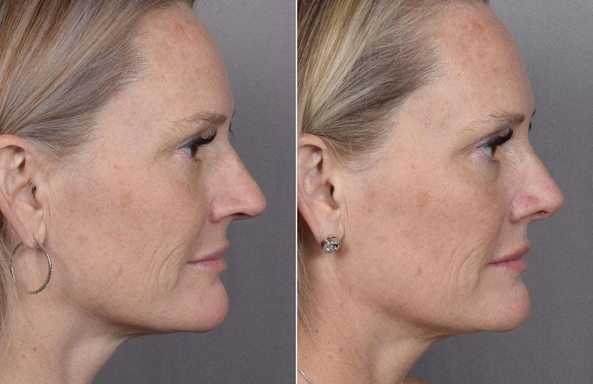 Rhinoplasty Before & After Gallery - Patient 149951 - Image 3