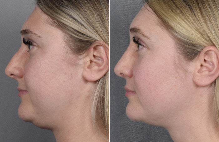 Rhinoplasty Before & After Gallery - Patient 413508 - Image 1