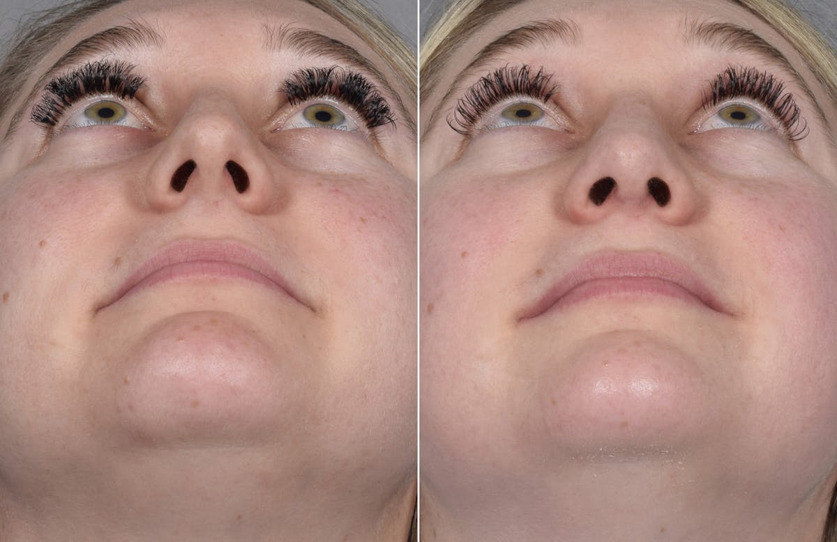 Rhinoplasty Before & After Gallery - Patient 413508 - Image 8