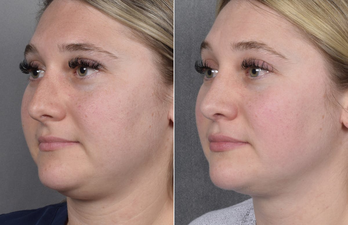 Rhinoplasty Before & After Gallery - Patient 413508 - Image 5