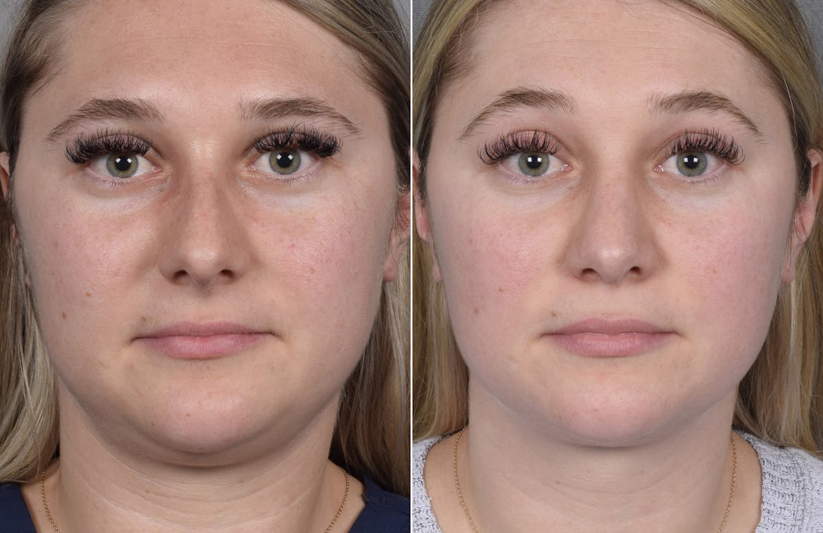 Rhinoplasty Before & After Gallery - Patient 413508 - Image 7