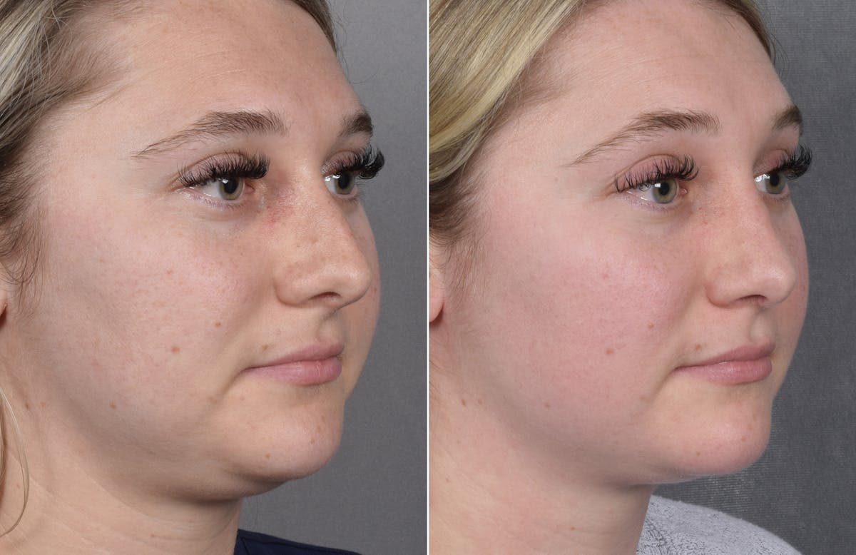 Rhinoplasty Before & After Gallery - Patient 413508 - Image 6