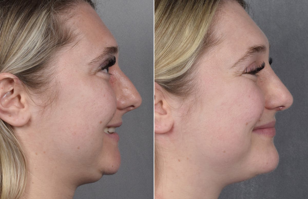 Rhinoplasty Before & After Gallery - Patient 413508 - Image 4