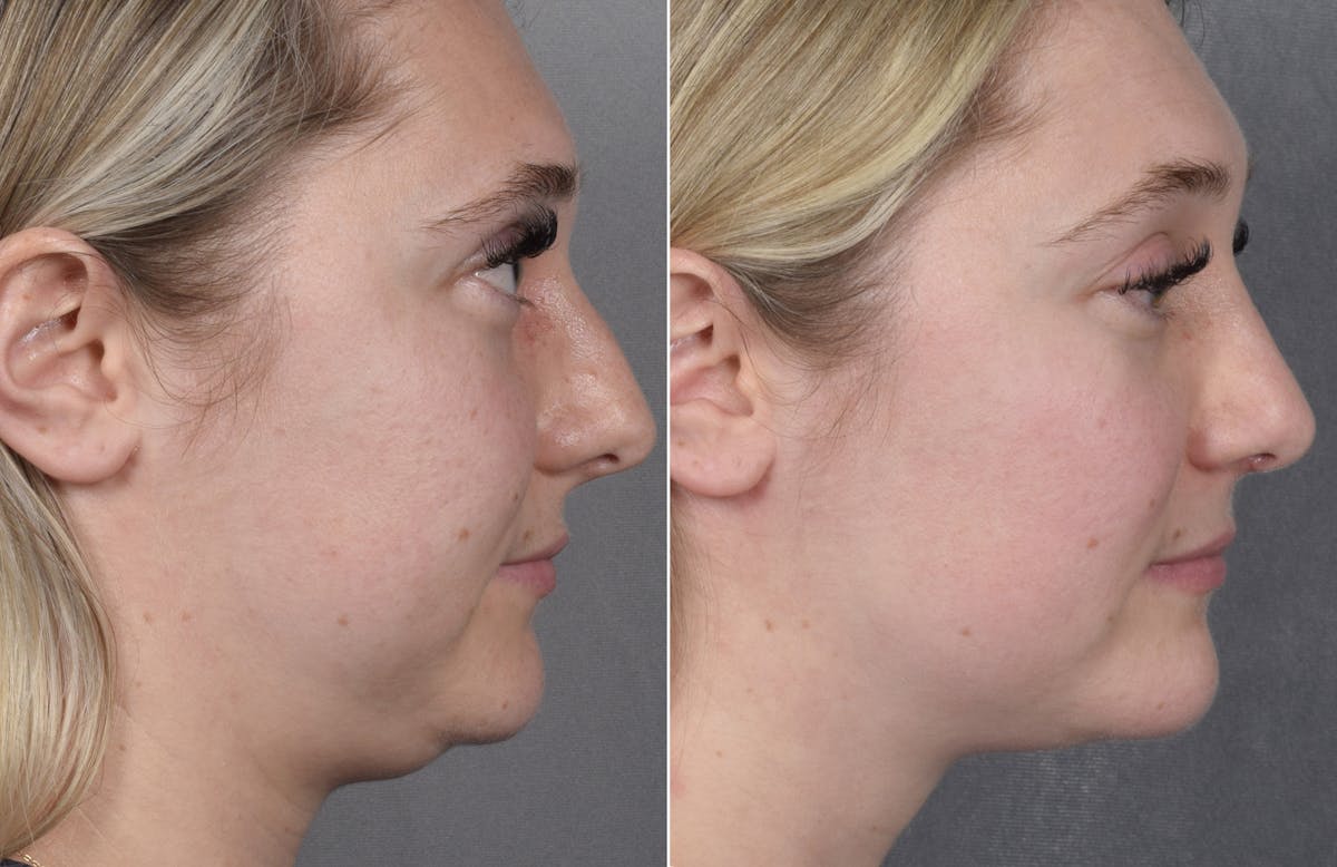 Rhinoplasty Before & After Gallery - Patient 413508 - Image 3