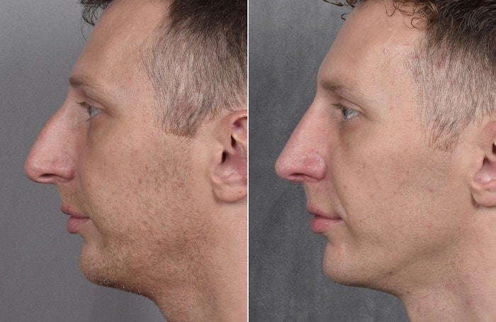Rhinoplasty Before & After Gallery - Patient 134033 - Image 1