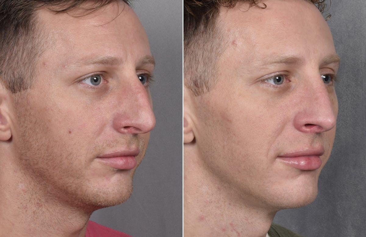 Rhinoplasty Before & After Gallery - Patient 134033 - Image 3
