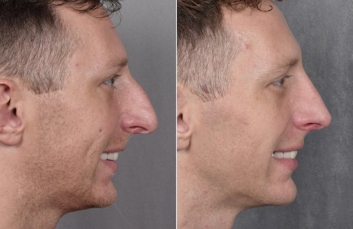 Rhinoplasty Before & After Gallery - Patient 134033 - Image 4