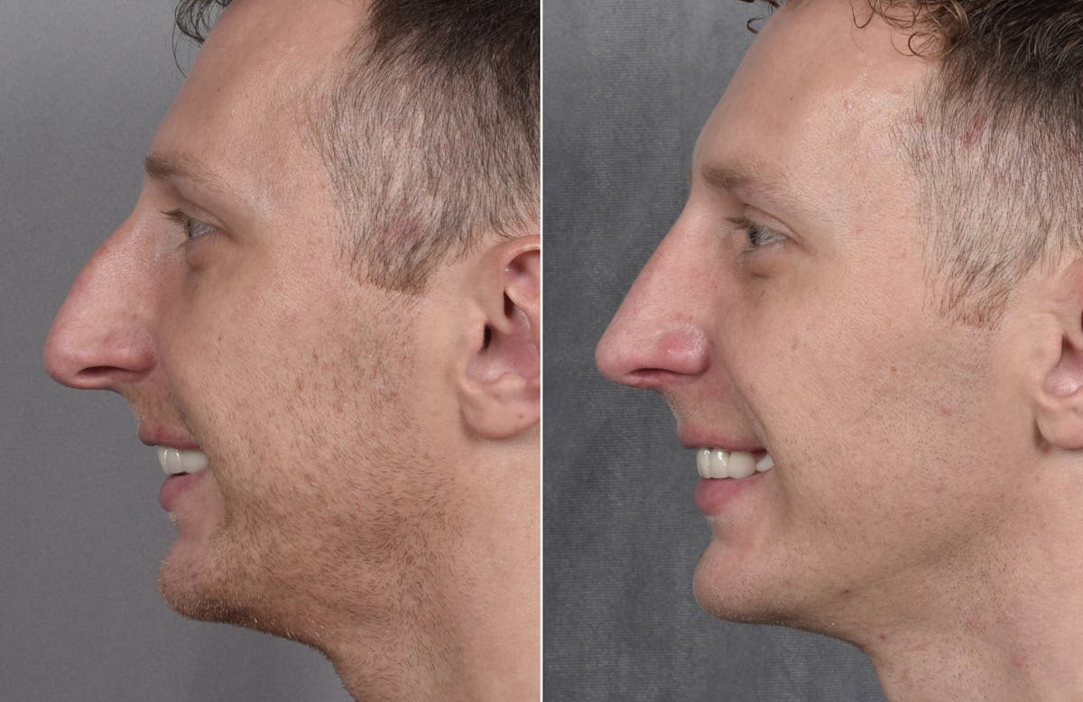 Rhinoplasty Before & After Gallery - Patient 134033 - Image 5