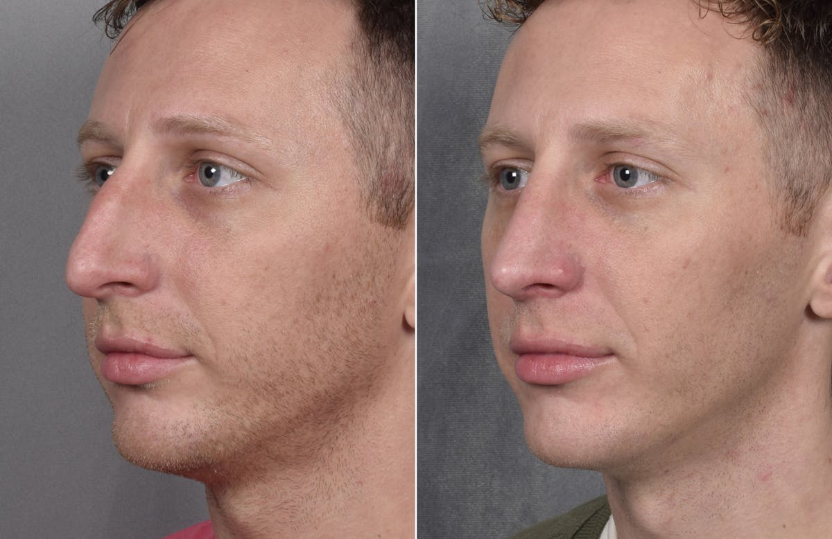 Rhinoplasty Before & After Gallery - Patient 134033 - Image 6
