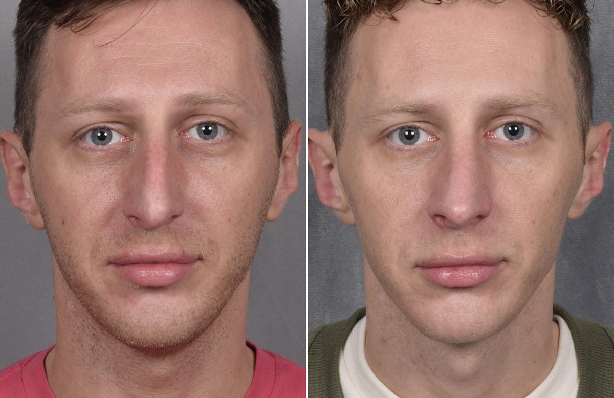Rhinoplasty Before & After Gallery - Patient 134033 - Image 7