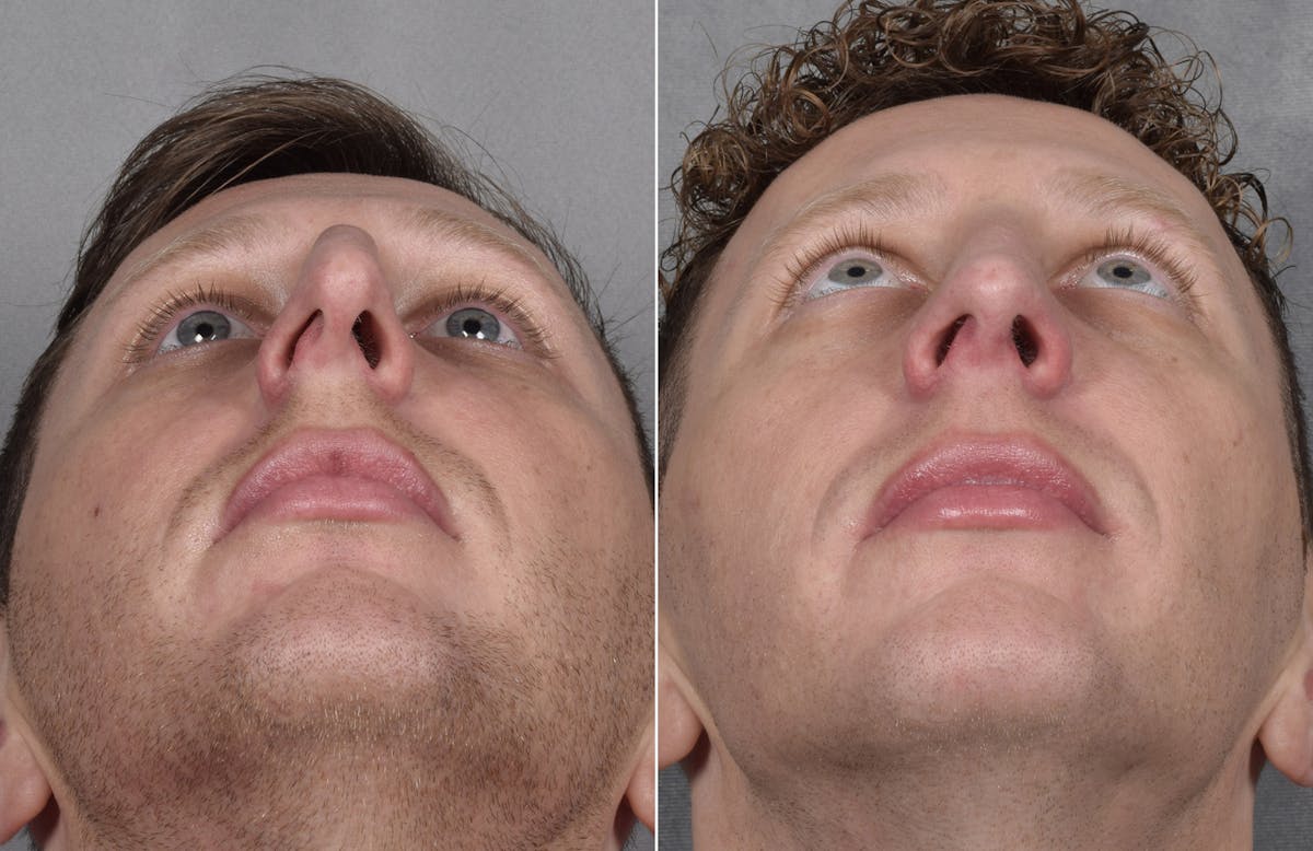 Rhinoplasty Before & After Gallery - Patient 134033 - Image 8