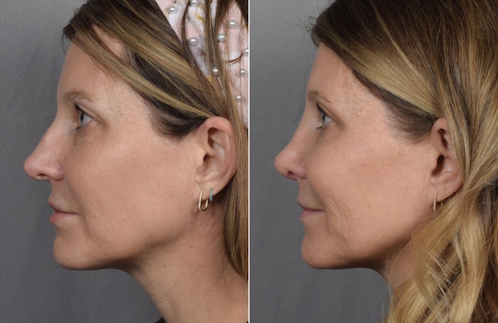 Rhinoplasty Before & After Gallery - Patient 398408 - Image 1
