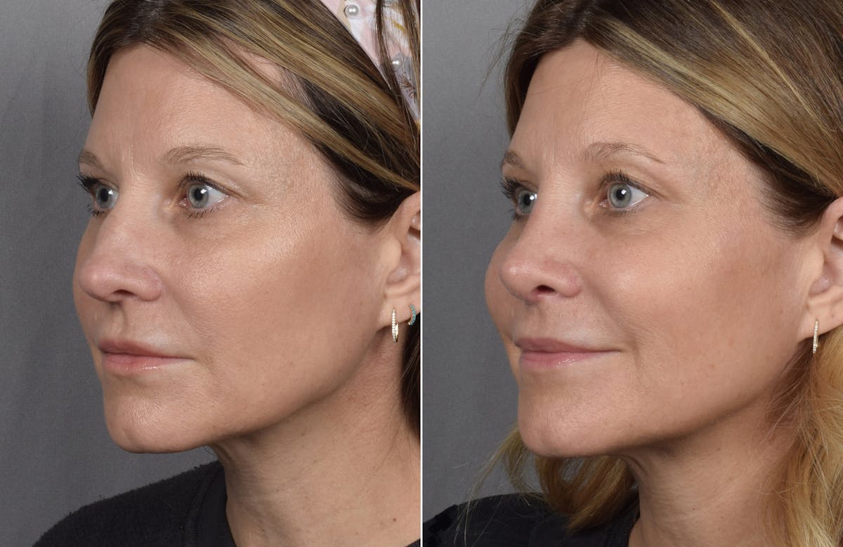 Rhinoplasty Before & After Gallery - Patient 398408 - Image 5