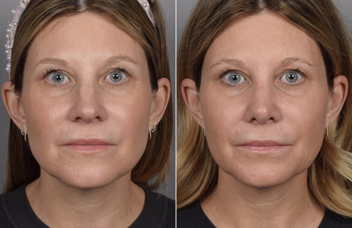 Rhinoplasty Before & After Gallery - Patient 398408 - Image 6