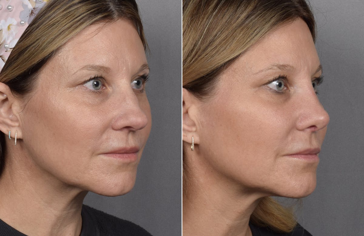 Rhinoplasty Before & After Gallery - Patient 398408 - Image 4