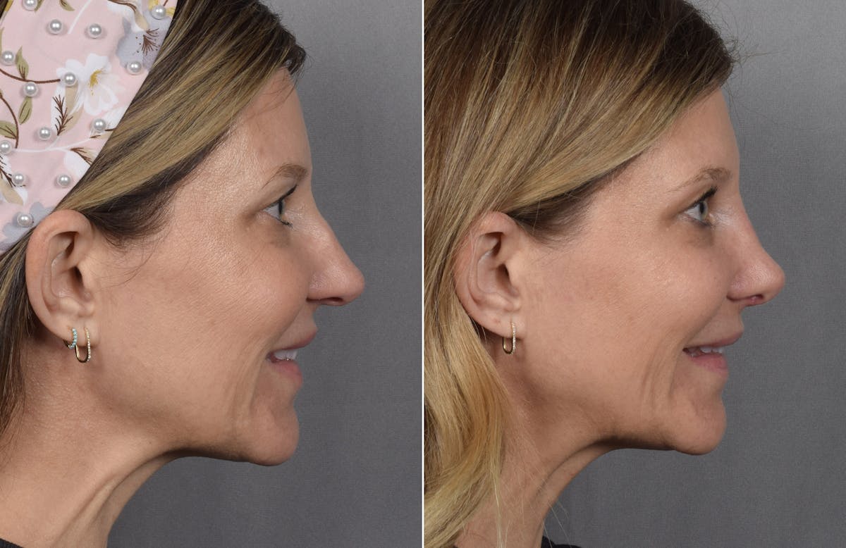 Rhinoplasty Before & After Gallery - Patient 398408 - Image 3