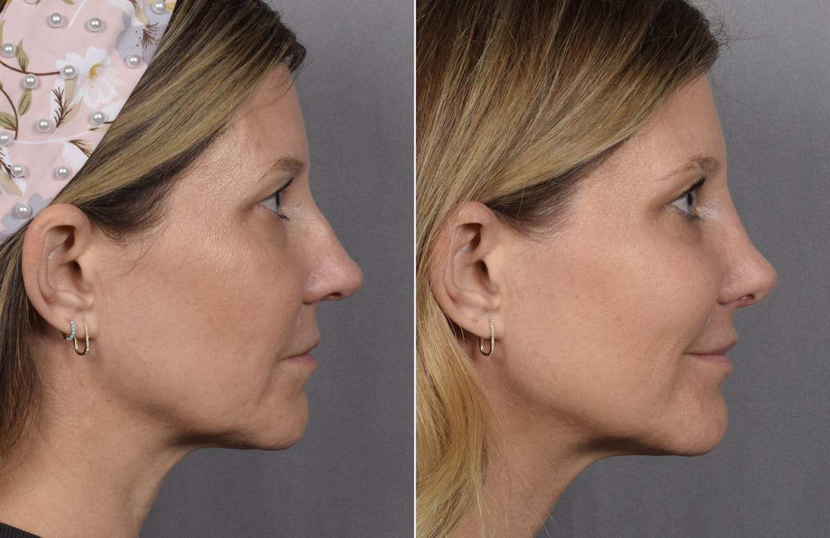 Rhinoplasty Before & After Gallery - Patient 398408 - Image 2