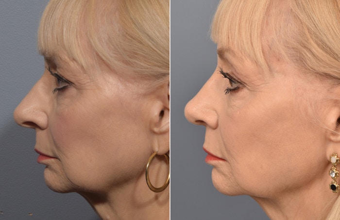 Rhinoplasty Before & After Gallery - Patient 634088 - Image 1