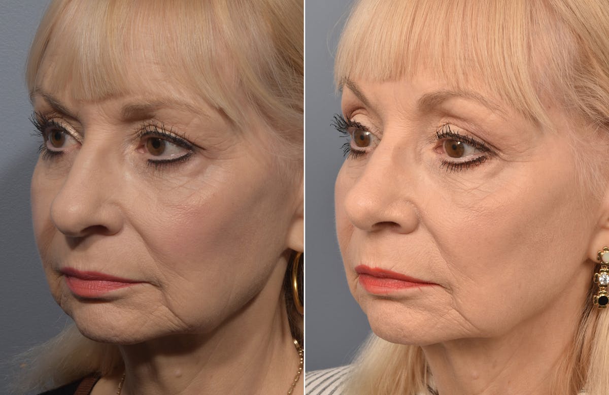 Rhinoplasty Before & After Gallery - Patient 634088 - Image 4