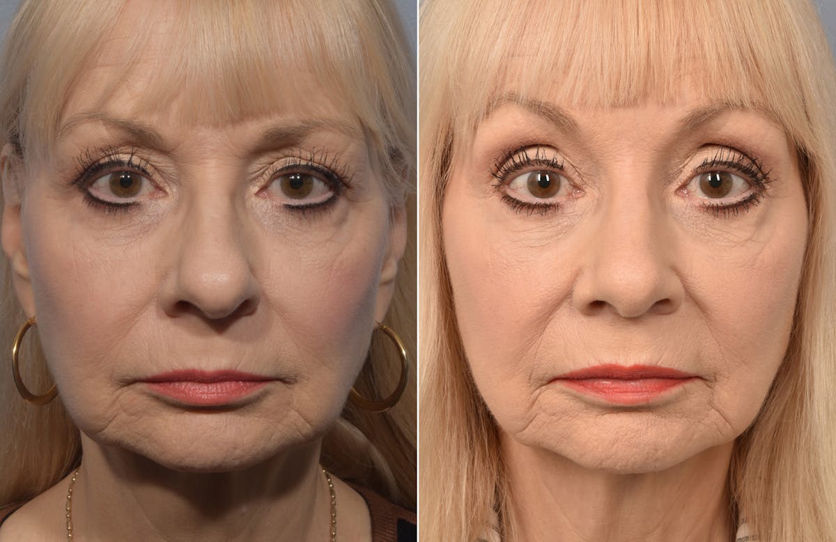 Rhinoplasty Before & After Gallery - Patient 634088 - Image 5