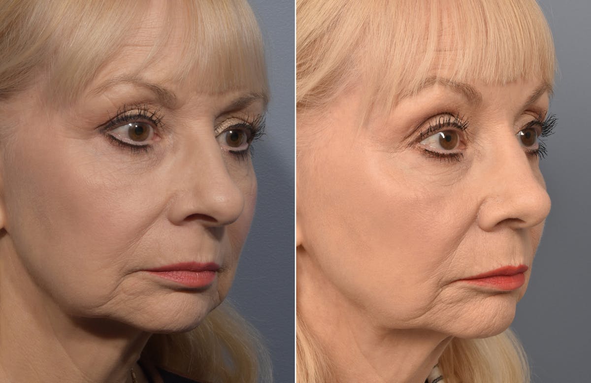 Rhinoplasty Before & After Gallery - Patient 634088 - Image 3