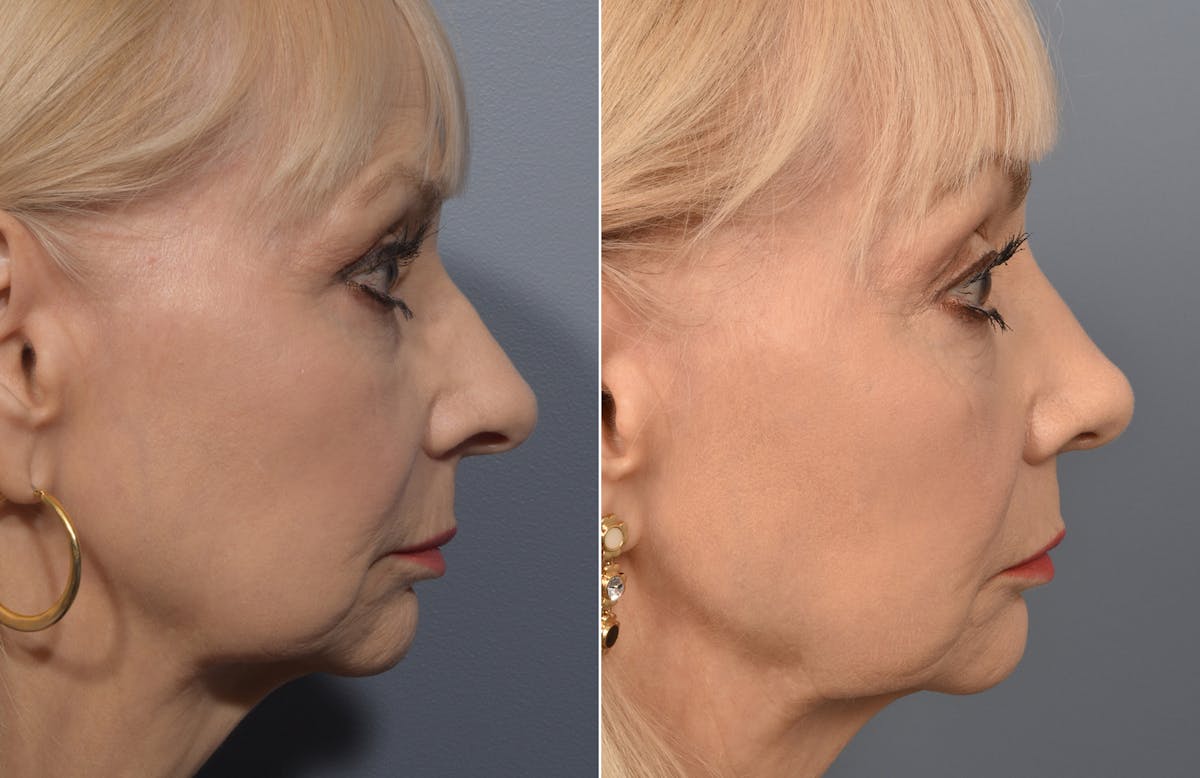 Rhinoplasty Before & After Gallery - Patient 634088 - Image 2