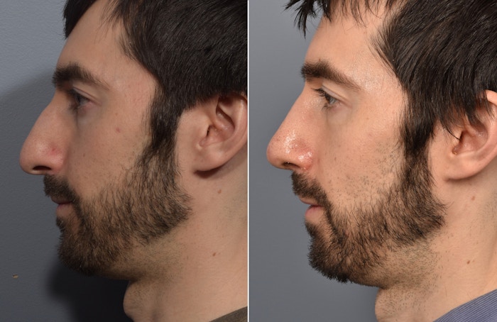 Rhinoplasty Before & After Gallery - Patient 168684 - Image 1