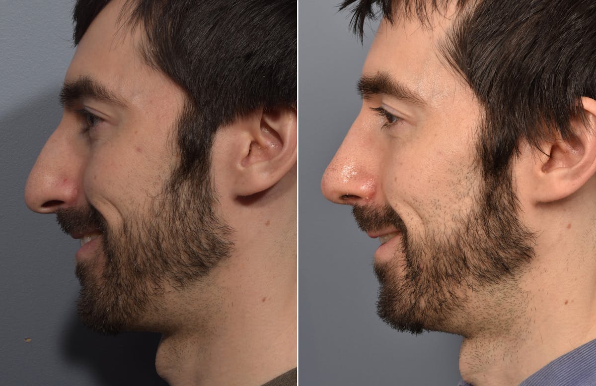 Rhinoplasty Before & After Gallery - Patient 168684 - Image 2