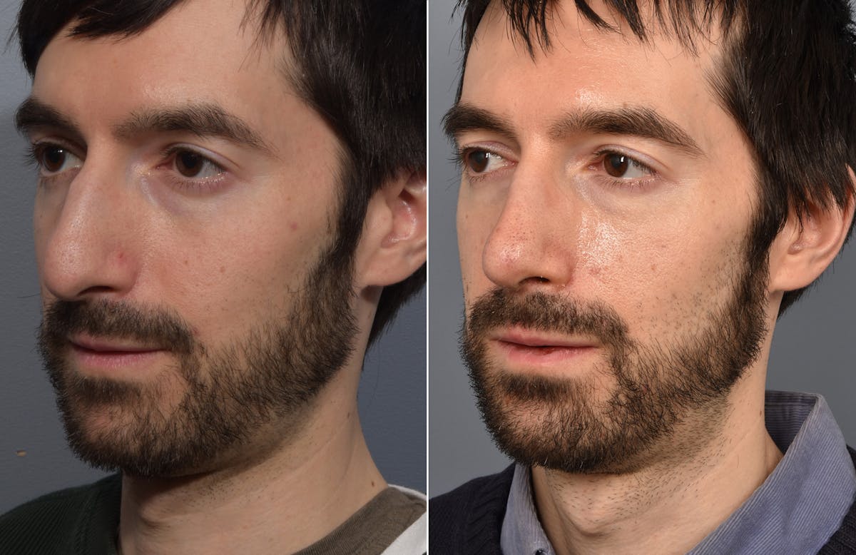 Rhinoplasty Before & After Gallery - Patient 168684 - Image 5