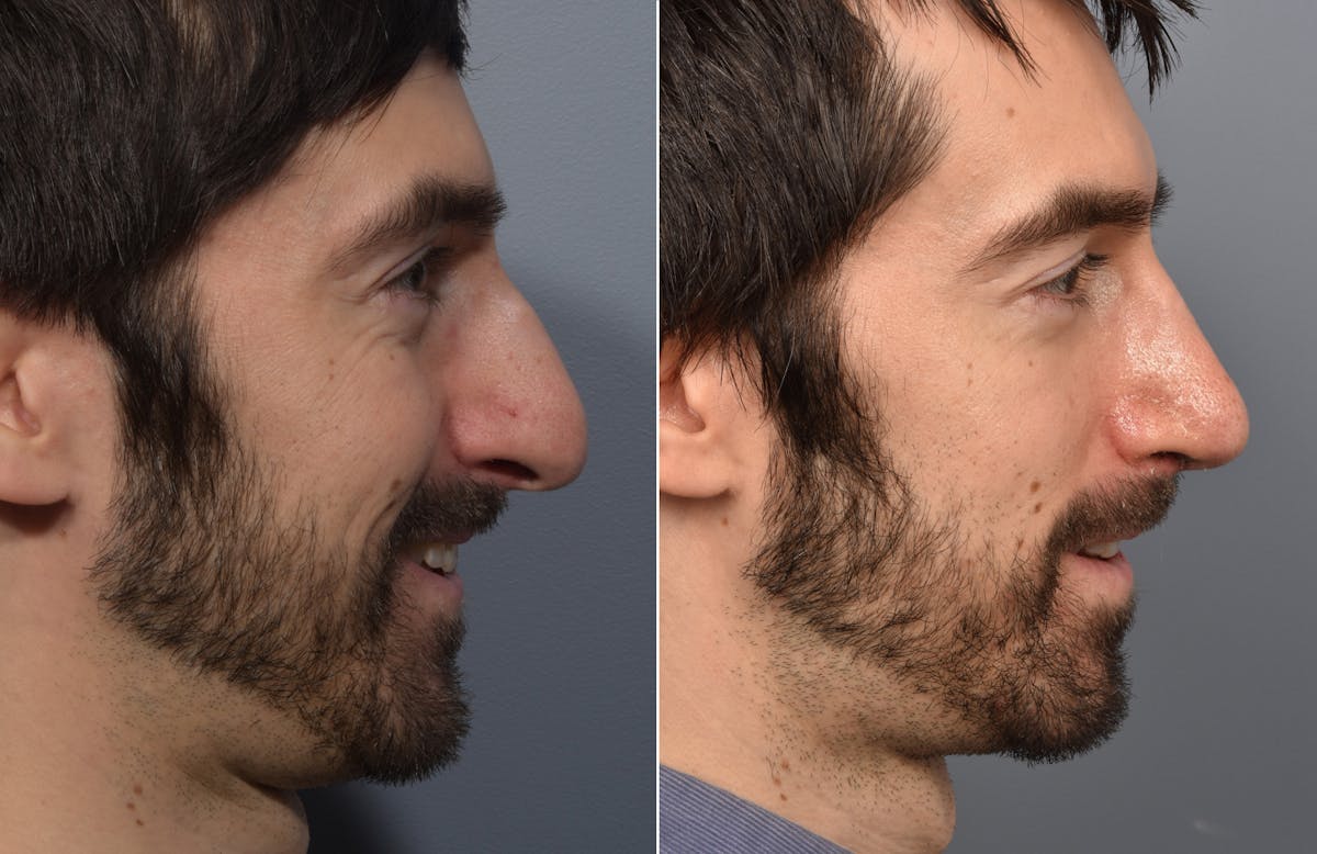 Rhinoplasty Before & After Gallery - Patient 168684 - Image 4