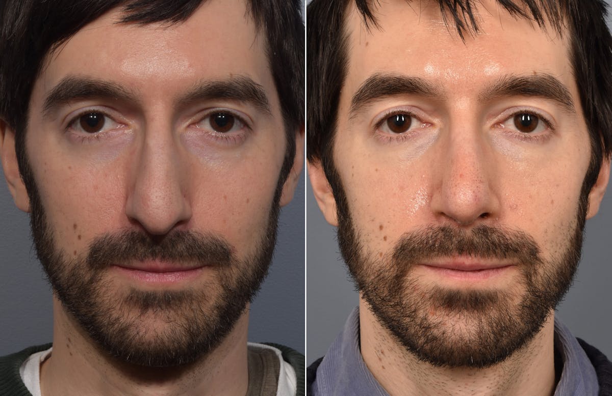 Rhinoplasty Before & After Gallery - Patient 168684 - Image 7